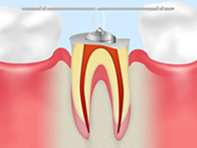 できるだけ抜歯しないむし歯治療：エクストリュージョン法